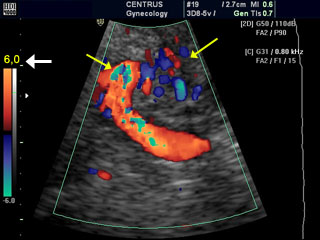Doppler Ultrasounds helps check better growth of infants internal organs
