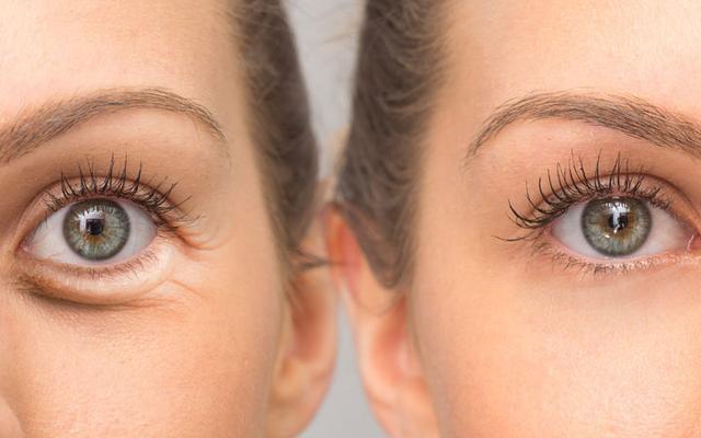 home remedies for wrinkles under the eye