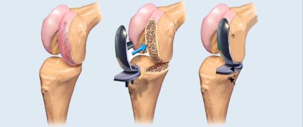 total knee replacement surgery