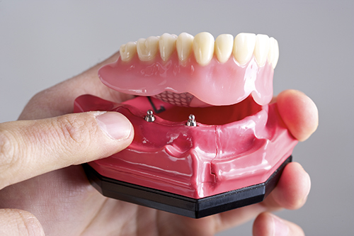 implant dentures dental